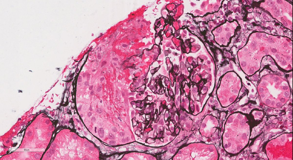 JZRenalPath's tweet image. Older patient with AKI, asthma, and eosinophilia. Bx with pauci-immune necrotizing/crescentic GN. Eosinophils everywhere. Clinical diagnosis is EGPA. #renalpath