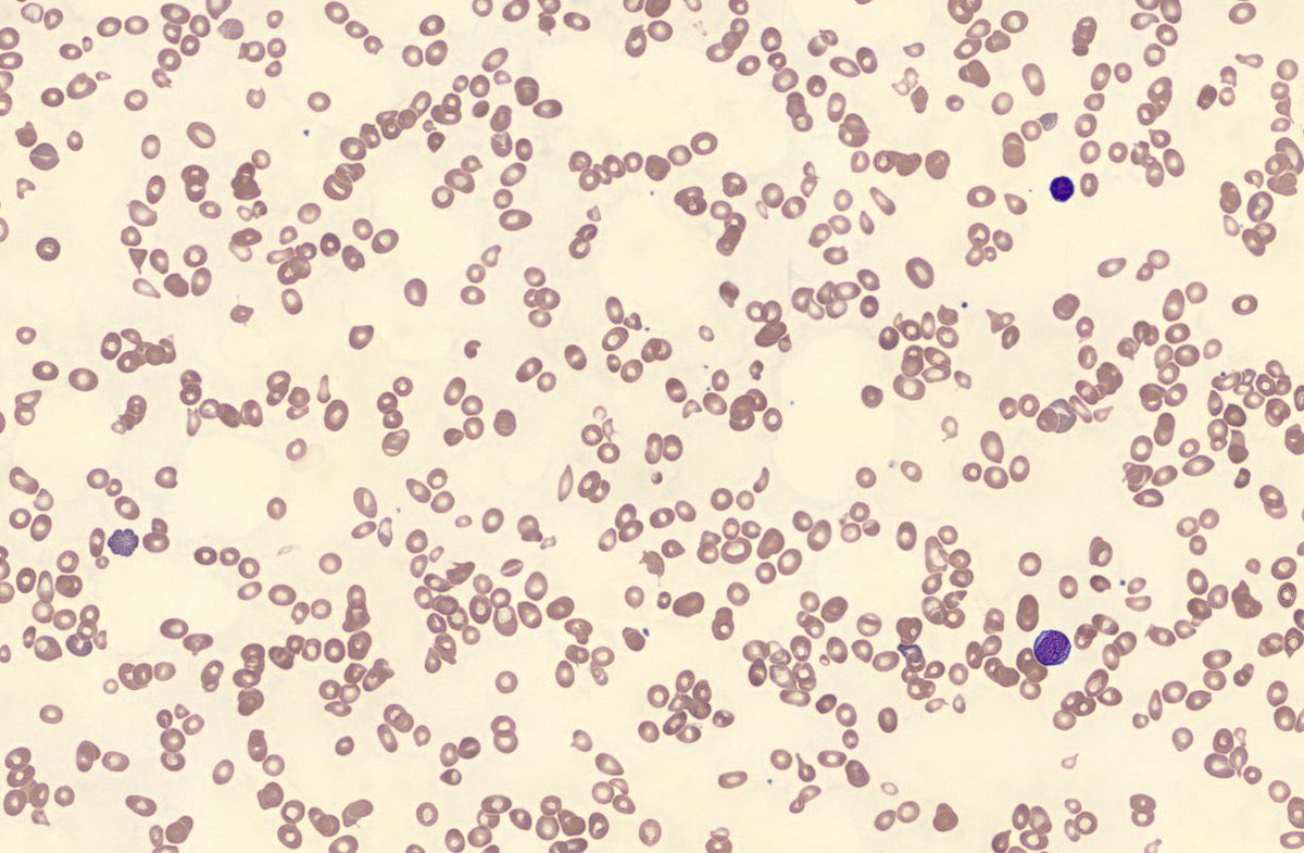 HIV, Hepatitis Panel, and other infectious serologies were negative. Yeah, COVID19 was negative tooPeripheral smear showed Anisopikilocytosis and schistocytes and...hypersegmented NeutrophilsWhat’s highest on your ddx now?