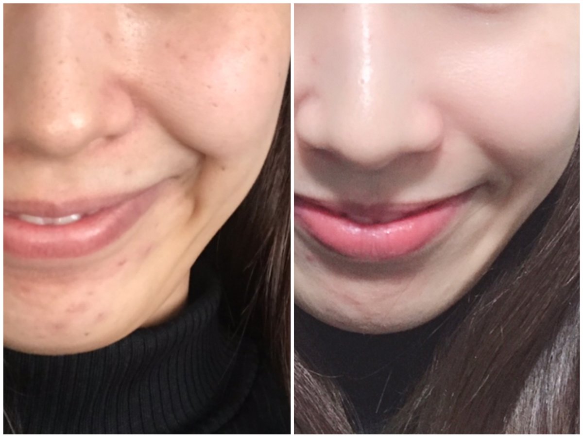 Mi Zu Ho 32歳 潰したニキビが茶色く色素沈着してて自分の顔がすごい嫌いでした メルラインを見つけて 皮膚科医も推してたので買ってみました 徐々にニキビ跡も消えていき 今ではスッピンでどこでも行けるくらい綺麗になりました