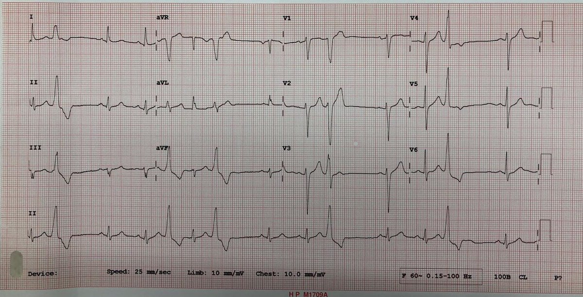 ismailblbn's tweet photo. #EPeeps 40 y Man, 28% PVC burden, SOO? @taylanakgun @ayhankup @U_Cnplt @MDTolgaAksu @DursunAras2 @Hapa_EP @gokselcinier @SchakrabartiEP @prof_serkan_cay @ALFIEEP1 https://t.co/yu1NF0J46z