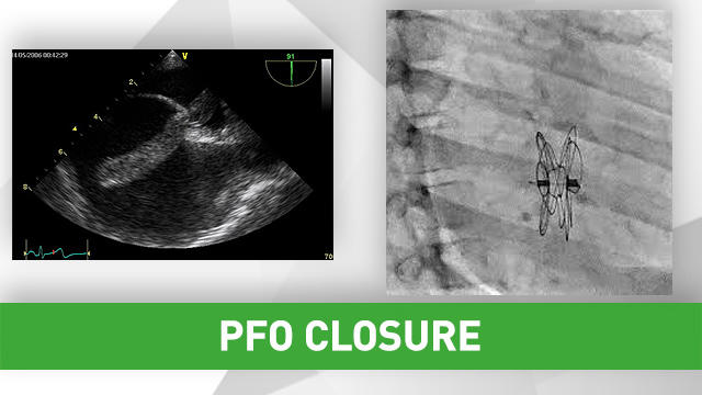 PCRonline's tweet image. How to make PFO closure a safe and effective procedure?Take your practice to the next level during this free webinar on 23 October 2020!
👉bit.ly/30tpps2