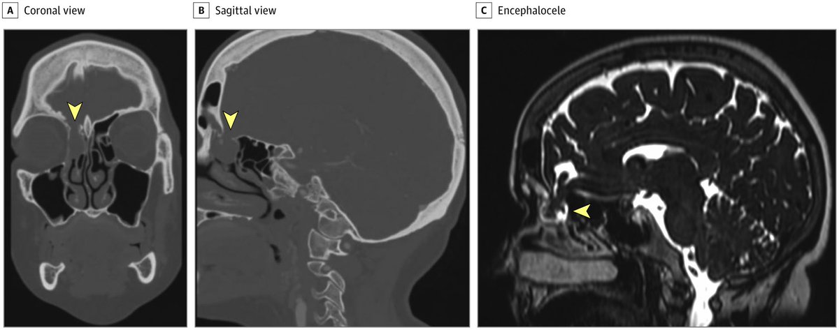 ￼￼Le scanner (les deux images de G) et l'IRM (à droite) montraient après l'intervention la présence d'une encephalocèle, c'est à dire la présence d'une "poche" de liquide céphalo-rachidien dans un endroit inhabituel, ici au niveau du nez (flèches jaunes).  #COVID19  #test 5/n