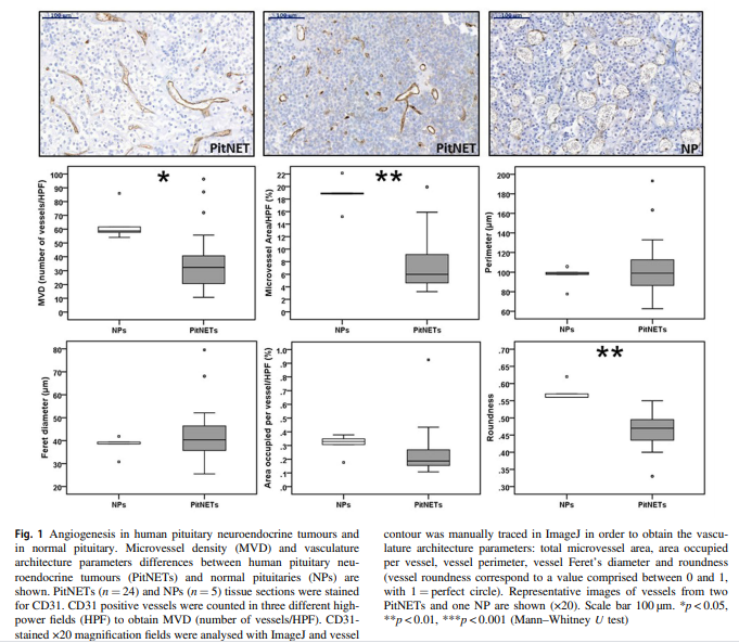 sociedadSEEN's tweet image. Los macrófagos M2 parecen desempeñar un papel en la neovascularización de #PitNET, mientras que los linfocitos B, CD4 + y FOXP3 +, así como los elementos TME no celulares como CCL2, CXCL10 y CX3CL1, también pueden modular la angiogénesis de #PitNETs 
ow.ly/BSxa30rbHtv