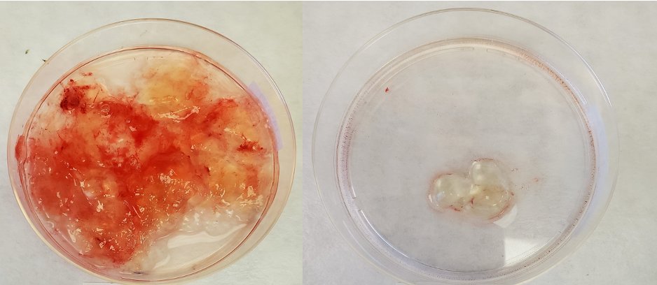 WFORCE and Mucpharm will work together to study Bromelain/NAC on mucin deposits and  tumor organoids. Below first pictures of BNAC effect on mucin produced by an appendiceal mucinous neoplasm (LAMN) after 3 hours of treatment.