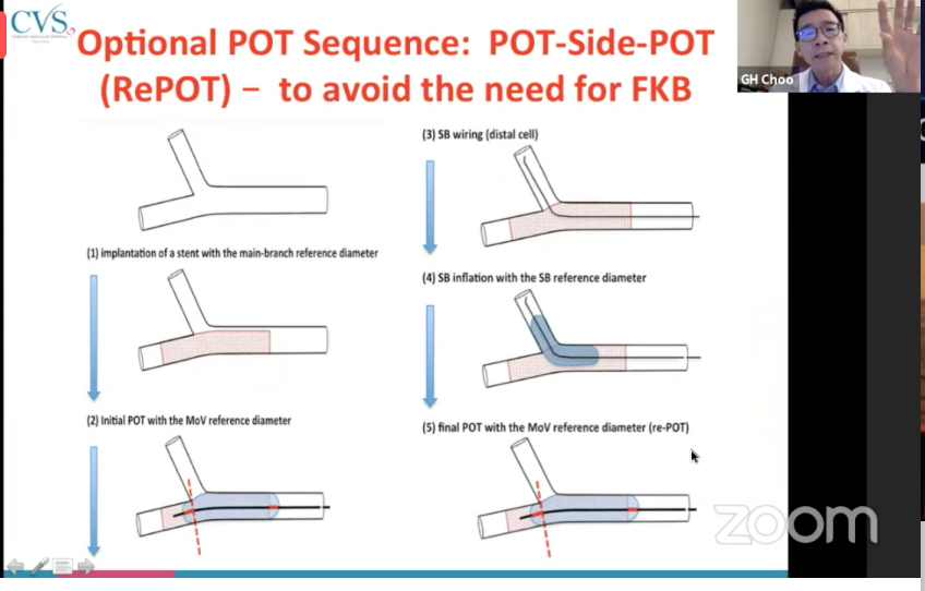 NishithChandra's tweet photo. POT technique in detail at #APSIC6 https://t.co/abhkkDTgxC