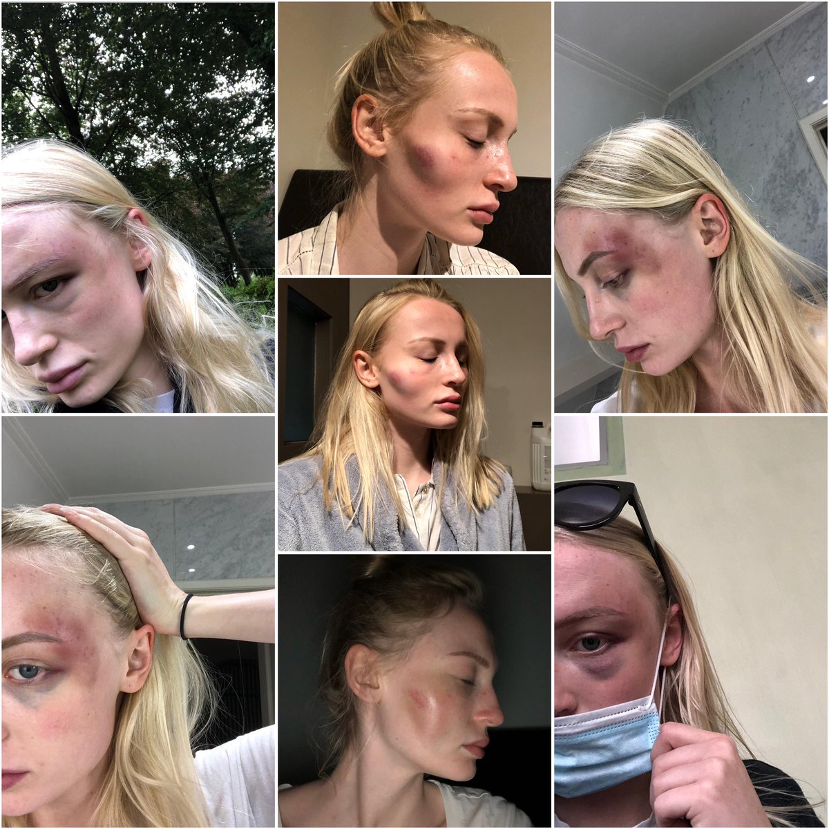 anthoniarochus's tweet photo. Dit is mijn before and after. Geen happy story. Geen groot geluk. Maar pijn en verdriet. Ook dit is hoe het kan gaan. Eindelijk heb ik de moed gevonden mijn verhaal te doen. Maar dit is niet het einde. Ik kom hier sterker dan ooit uit.

‘WHERE IT ALL STARTED vs. WHERE IT ENDED’ https://t.co/KKmxAuWGeS