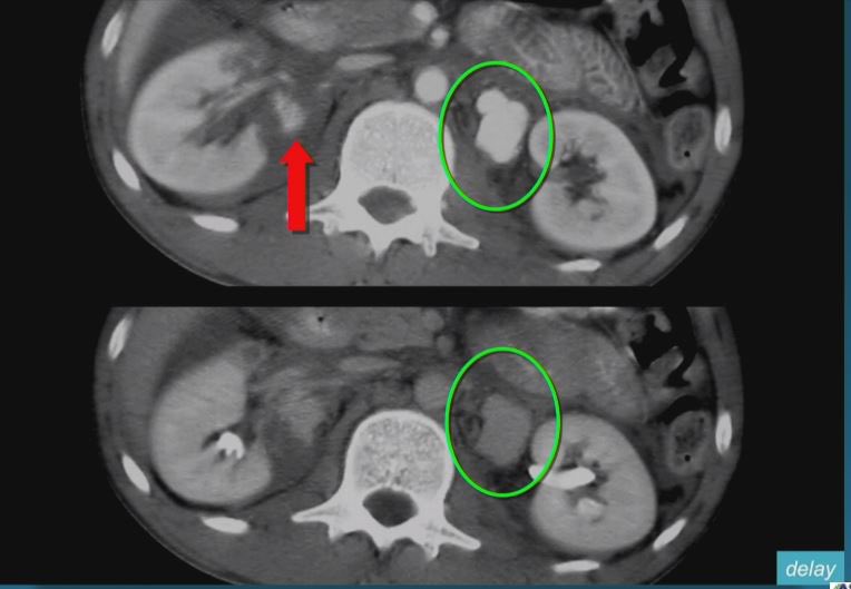 #ASER2020 <a href="/MarkBernsteinMD/">Mark Bernstein, MD, FASER 🇨🇦🇺🇸</a> teaching importance of multi-phase. 

Top: arterial. Bottom: delayed. Lobular pseudoaneurysm medial to left kidney confirmed bc of delayed (contained). With only one phase hard to distinguish from active extrav (uncontained vascular injury).

@ASER_ERad
