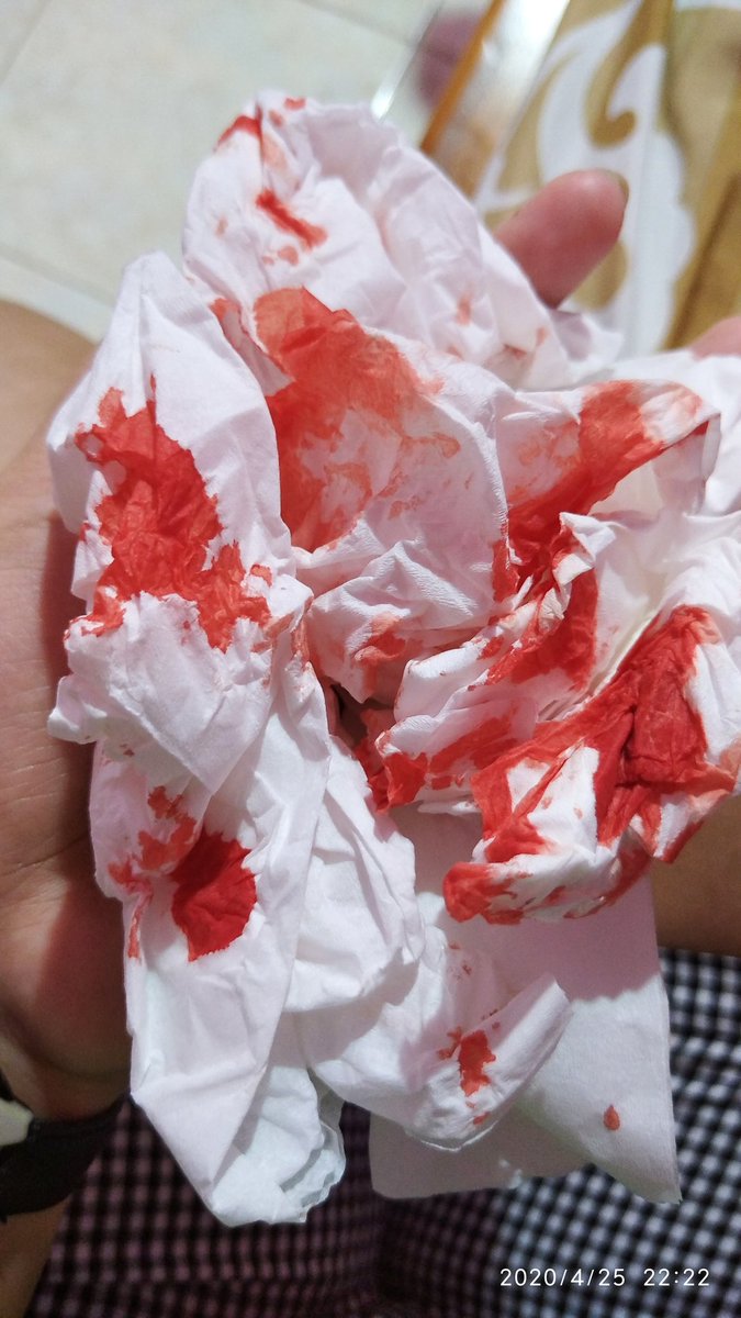 peapod_twt's tweet photo. @ailing60540091 @MyHappyJin ⚠️⚠️Trigger warn /blood/⚠️⚠️
It indeed looks like blood, sometimes I get a nosebleed if it's too cold, and the blood color looks bright like that😢😢😢 https://t.co/4dp1BQVUKd