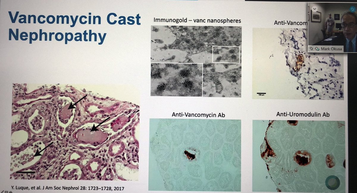 kidneymo's tweet photo. Dr. Mark Okusaโs presentation on AKI at #CCFNephUpdate2020 https://t.co/JEwJCURKkK