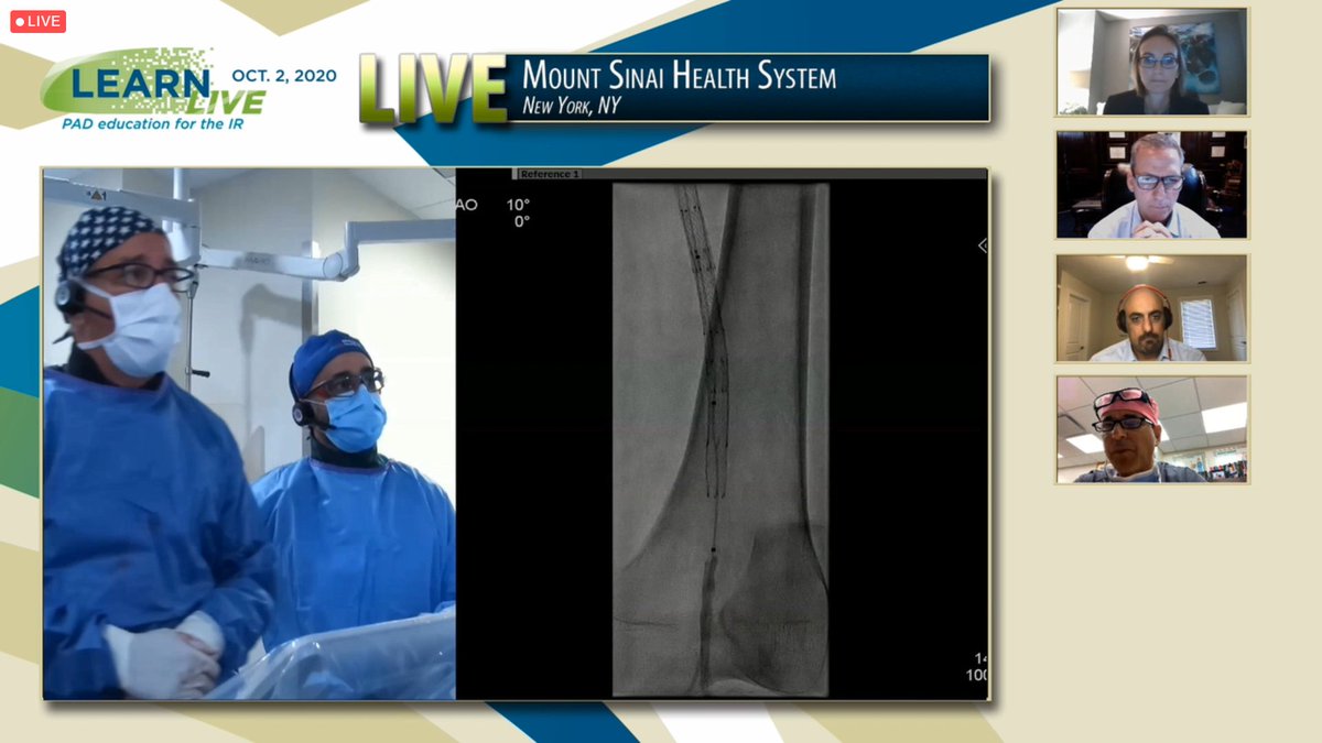 drShakMD's tweet image. GREAT #LIVEcase from @MountSinaiIR #LEARN2020. Wonderful way to learn virtually from the experts😃 #CLI #PAD #IRads @SIRRFS @SIRspecialists