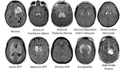UCSFimaging's tweet image. Integrating #DeepLearning &amp;amp; #BayesianNetworks for expert-level brain MRI diagnosis. New research from Drs. Jeffrey Rudie (@RadRudie), Andreas Rauschecker (@DrDreMDPhD) &amp;amp; team. bit.ly/30gVCCA
