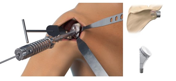 ArthrexMedEd's tweet photo. Join Albert Lin, MD, and Brad Parsons, MD, as they walk #ASES2020 attendees through a Univers Revers™ Apex with Augmented Glenoid Re-Live Surgery at 8:30 p.m. EST. See how  patient-specific instrumentation is Helping Surgeons Treat Their Patients Better™.https://t.co/4Dj5riJkpg https://t.co/0KRGCovu4H