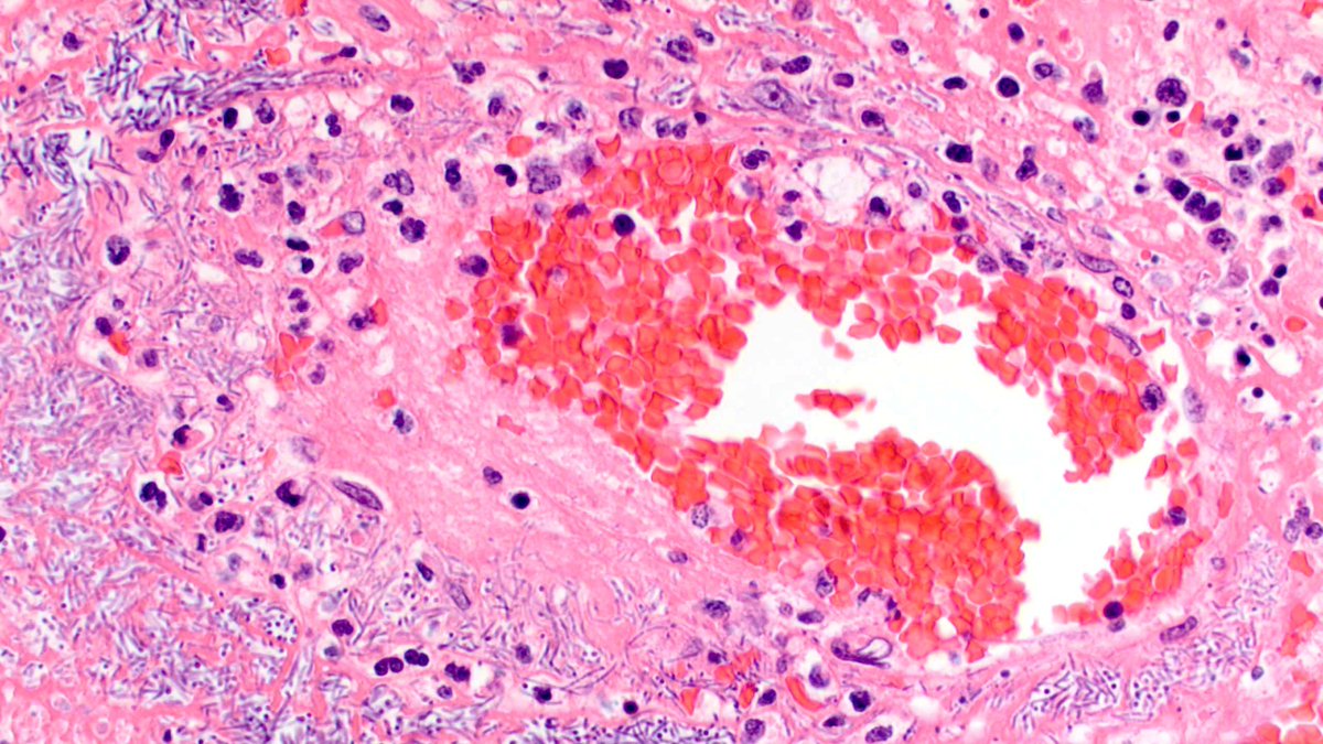 Vik_deshpandeMD's tweet image. Ladies  and Gentlemen - if this doesn't blow your mind, nothing ever will! History of small bowel perforation. Enjoy! #GIPath PS  Since Masala Dosas seem to be the flavor of  the day - that's what  you get if you diagnose this entity!