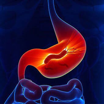 Helicobacter pylori: The StoryPeople actually thought that stress or spicy foods were what caused ulcer, it was not until 1982, when a pathologist, Dr. Robin Warren from Australia observed curved bacteria in most of the patients that suffered ulcer...A THREAD Help share