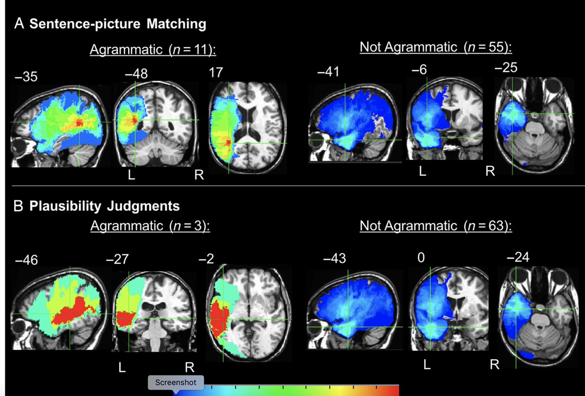 Finally, modern, large-scale lesion studies of sentence comprehension, including lesion correlates of agrammatic comprehension and VLSMs of object-extracted sentence comprehension, point directly at the temporal lobe.  https://pubmed.ncbi.nlm.nih.gov/29064339/ 