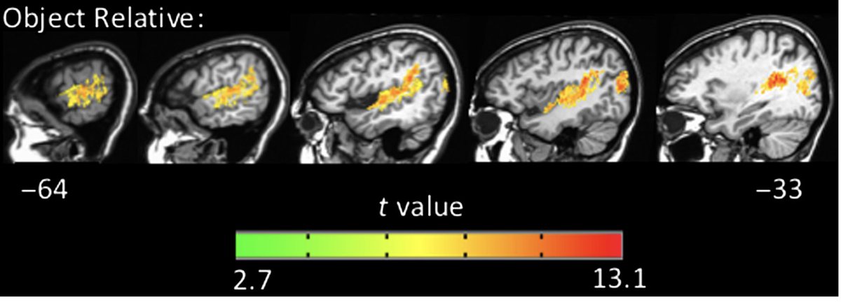 Finally, modern, large-scale lesion studies of sentence comprehension, including lesion correlates of agrammatic comprehension and VLSMs of object-extracted sentence comprehension, point directly at the temporal lobe.  https://pubmed.ncbi.nlm.nih.gov/29064339/ 
