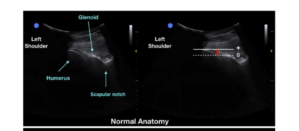 Revivan75's tweet photo. #POCUS to Diagnose Dislocated/fractures Shoulders
➡️ sens 100% spec 100% dislocation
➡️ Sens 92% spec 100% non-Hill-Sachs/Bankart's fractures of the humerus
https://t.co/meOSf3mbap @Wilkinsonjonny
@DRsonosRD
@NephroP  @PittIMPOCUS @POCUS_Society @WINFOCUS https://t.co/DkPpqsXSwo