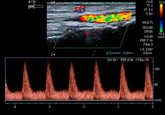 Revivan75's tweet photo. The FAST D protocol: a simple method to rule out traumatic vascular injuries of the lower extremities. Sens and spec 100% #POCUS #FOAMed @ResaELewiss @PittIMPOCUS @NephroP @Wilkinsonjonny @POCUSAcademy https://t.co/lUFnBKlI6l https://t.co/vUpcHeZssP