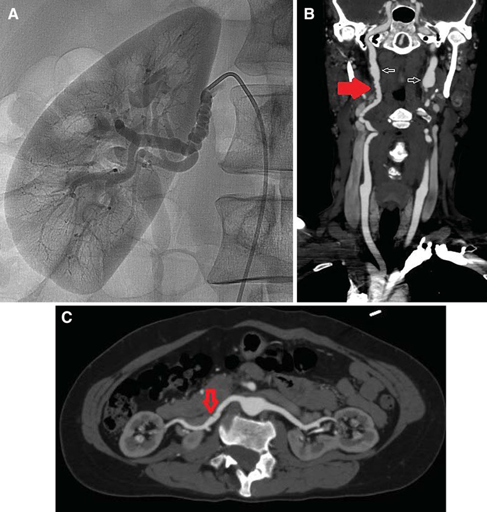 Joseph Vassalotti, MD (@joe_vassalotti) on Twitter photo <a href="/DFCapodanno/">Davide Capodanno</a> SCAD think systemic arteriopathy rather than atherosclerosis, especially fibromuscular dysplasia (FMD) with multifocal involvement of carotid and renal arteries commonly.
bit.ly/36us8p0 <a href="/DFCapodanno/">Davide Capodanno</a> SCAD think systemic arteriopathy rather than atherosclerosis, especially fibromuscular dysplasia (FMD) with multifocal involvement of carotid and renal arteries commonly.
bit.ly/36us8p0