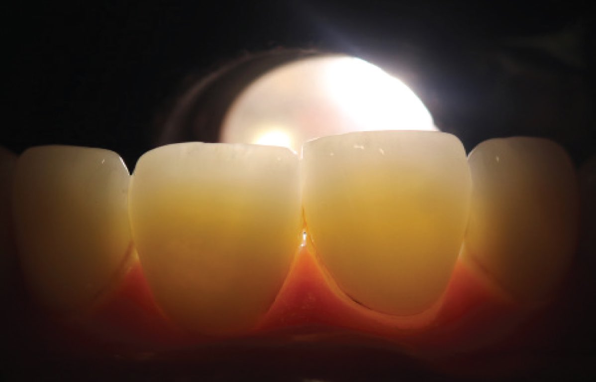 malshehri_dr's tweet photo. #transillumination help to diagnose certain conditions, such as #cracks or if you're looking for #canal #orifices, or trying to detect #interproximal #caries https://t.co/aMSv5pkJYq