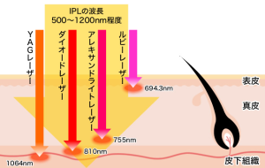 湘南美容外科 改めクリニック の ウルトラ美肌脱毛 マシン編 効果編1 2 Togetter