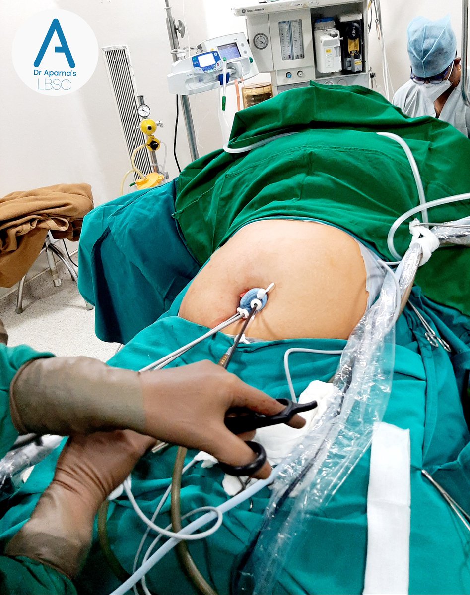 aparnabhasker's tweet photo. Even after a decade of performing Single Incision Surgeries, every time the results amaze me. 
Being a surgeon is about being #kind and what can be kinder than causing the least trauma to your patients.
#singleincisionsurgery #gastricsleeve #bariatricsurgery #SILS https://t.co/pBEw0Dl01K