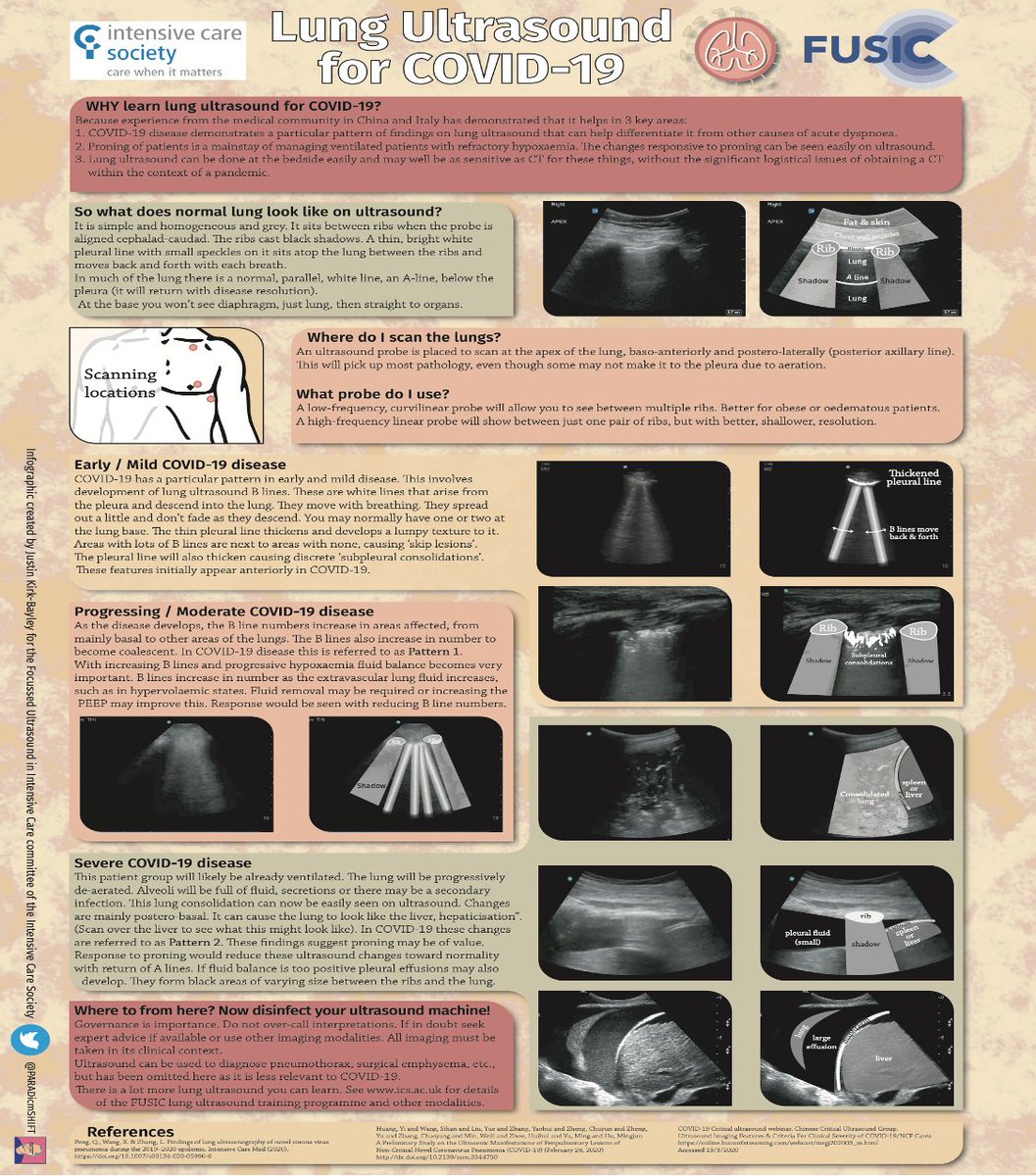 6/10 Lung ultrasound has been proving its worth in  #pocusforcovid. Some essential resources  #BARA2020  http://www.ics.ac.uk/ICS/ICS/FUSIC/FUSIC_COVID-19.aspx …https://associationofanaesthetists-publications.onlinelibrary.wiley.com/doi/10.1111/anae.15082  https://academic.oup.com/ehjcimaging/article/21/9/941/5855021
