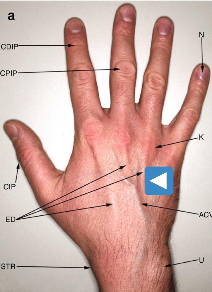 About the location on the hand, and why that matters:Unlike a simple blood draw, placing a hand IV requires that the tip of the catheter be unobstructed to a *flexible plastic tube*Placing the IV as marked below generally yields a secure, unobstructed IV.