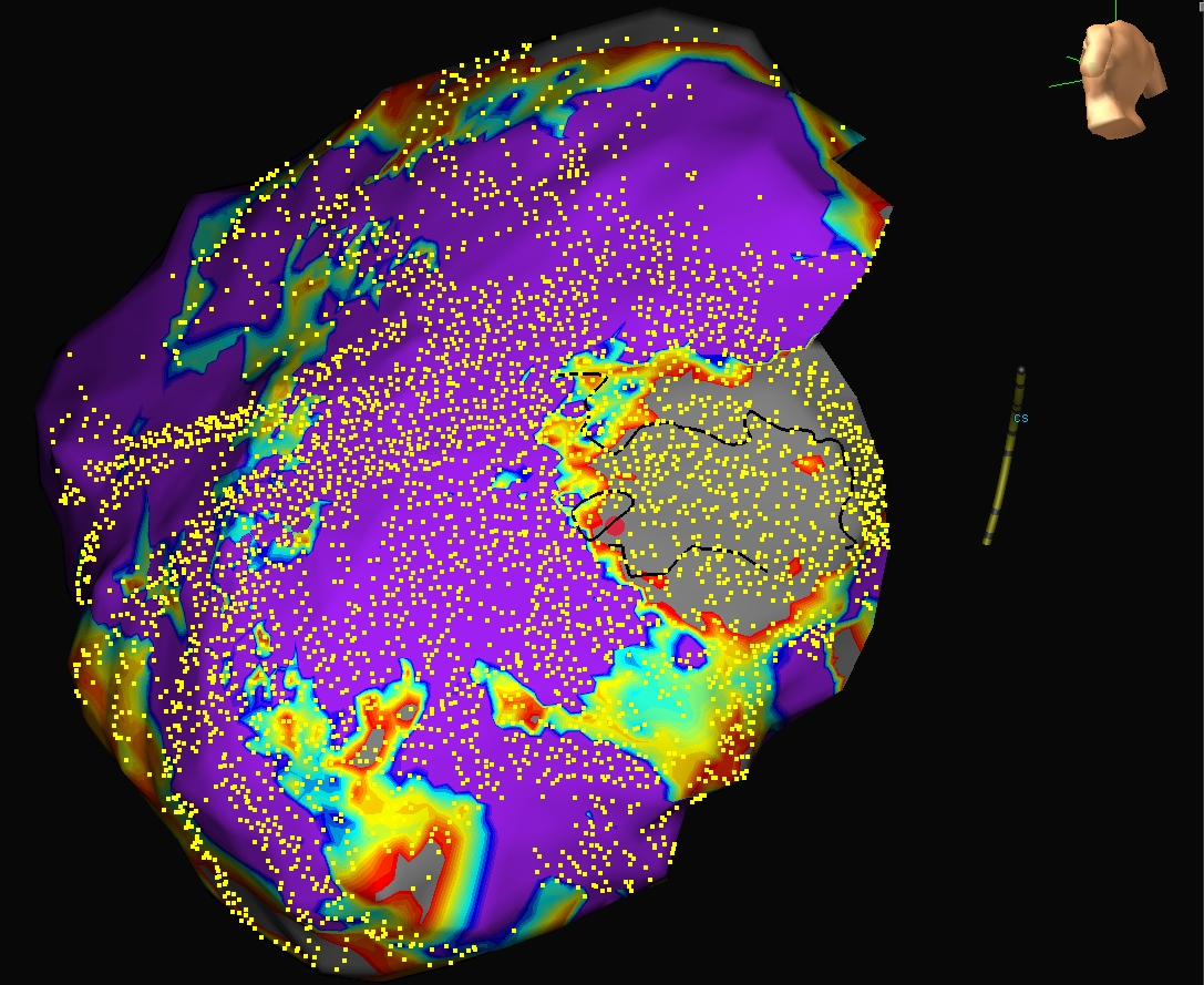 Daniel McKelvey (@dmckelvey11) on Twitter photo ILAM w/ extensive crowding, validation of a 3D tachycardia circuit (note the double jump), isthmus potentials and the obligatory termination. Isn’t it beautiful when the concepts come together? <a href="/Davilandre/">Andre d’Avila</a> ILAM w/ extensive crowding, validation of a 3D tachycardia circuit (note the double jump), isthmus potentials and the obligatory termination. Isn’t it beautiful when the concepts come together? <a href="/Davilandre/">Andre d’Avila</a>