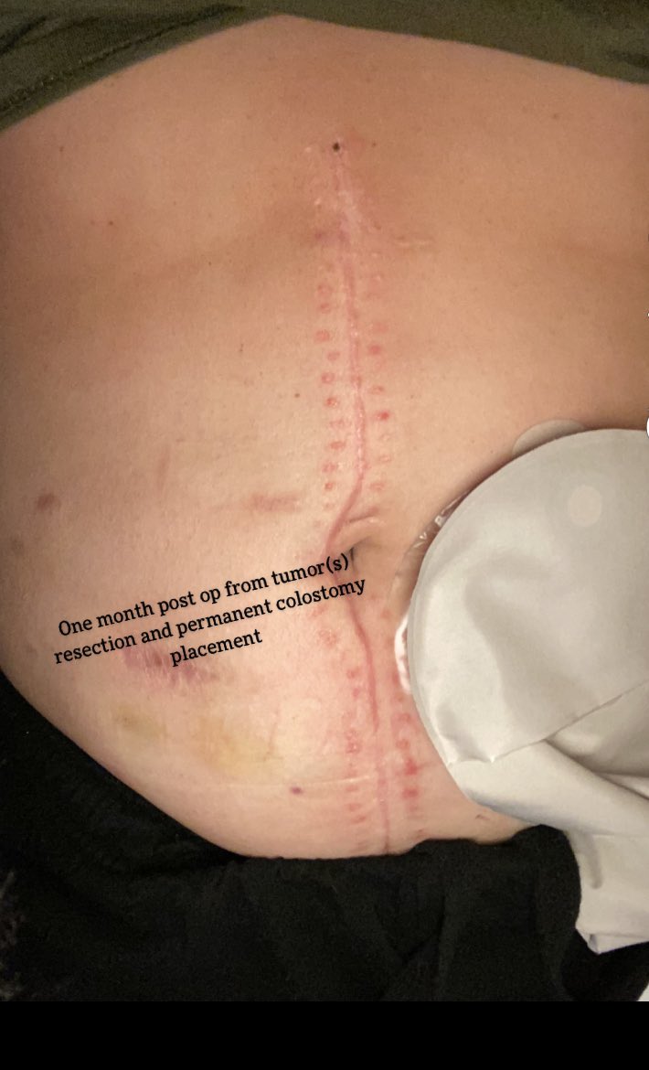 Brooke1698's tweet photo. Today is Ostomy Awareness Day 💫

#OstomyAwarenessDay #colostomy #stoma #letsendthestigma #stage4rectalcancer #cancerpatient #ostomyawareness #guthealth #selflove #bodyacceptance https://t.co/lILKAGl5a3