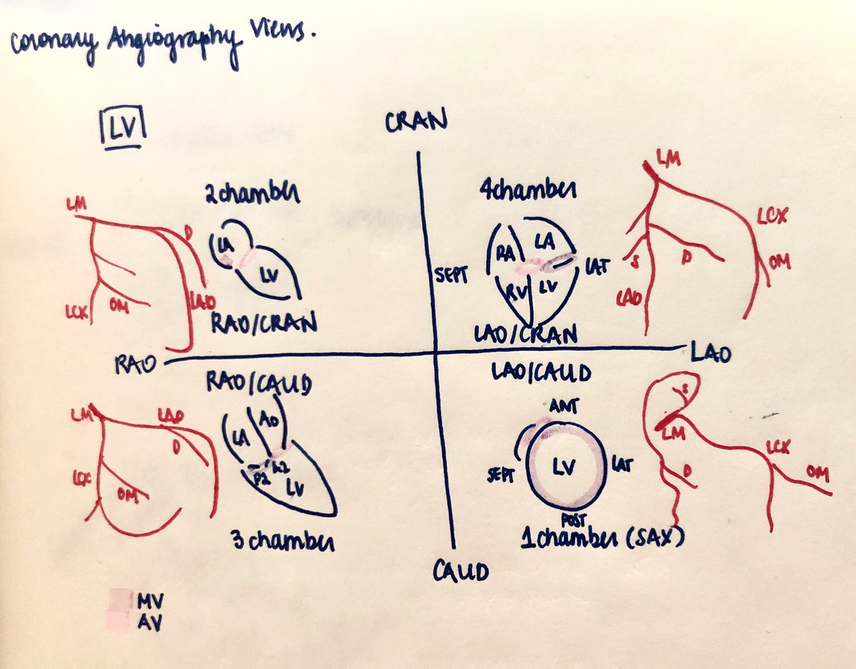 Applying the @nicolo_piazza method of translating fluoroscopy -> echocardiographic chamber views (pt with bioprosthetic AV & mitral ring). Highly recommend to #ACCFIT: bit.ly/34kiJxv. Imaging is 💯 the backbone of structural interventions! @sneha_vk @DellMedCardio