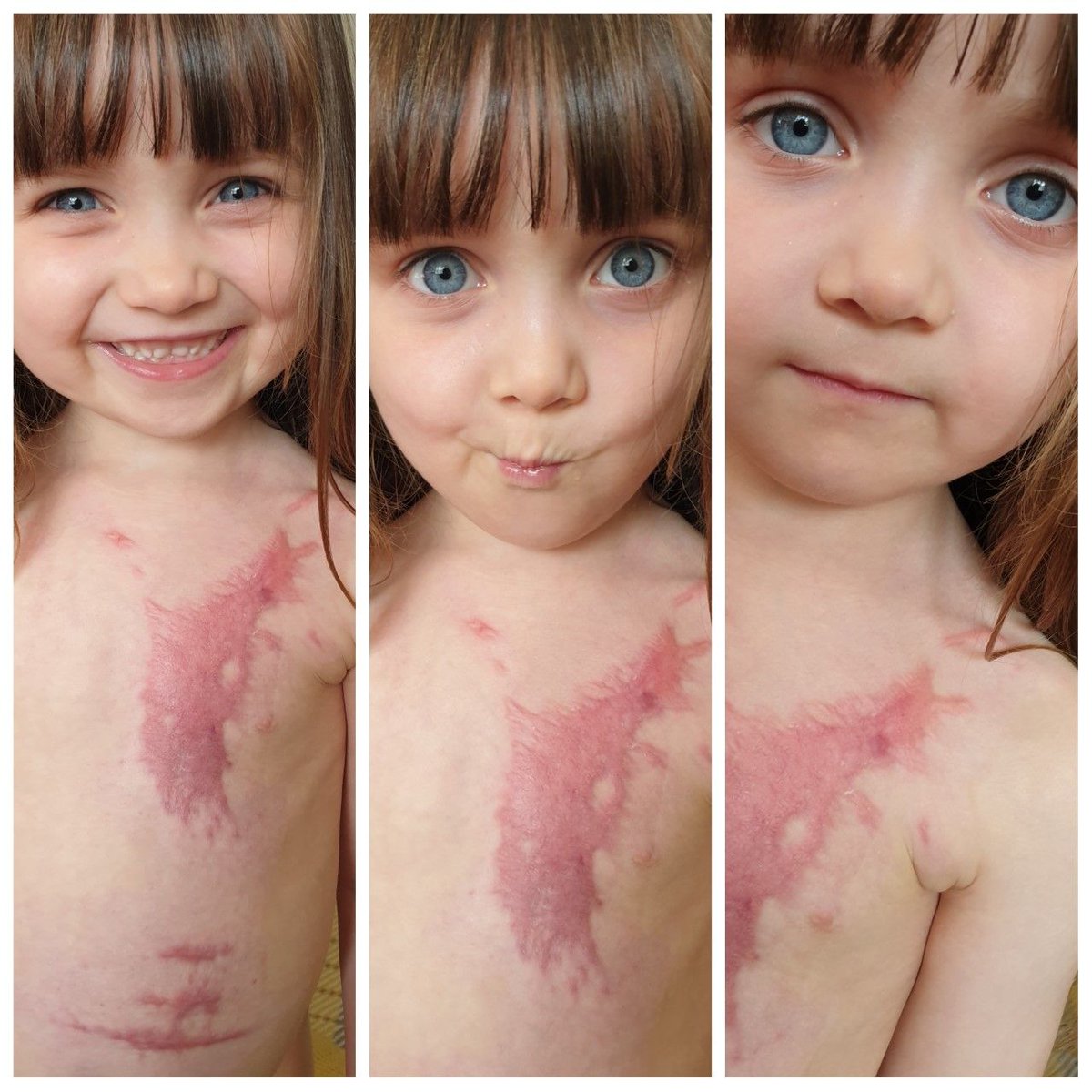 This is the reason National Burn Awareness Day is so important in raising awareness of how easily a child can be severely burned. Please Keep Hot Drinks Out Of Reach. A Burn Injury is for Life. #BeBurnsAware
cbtrust.org.uk/2020/10/02/bel…