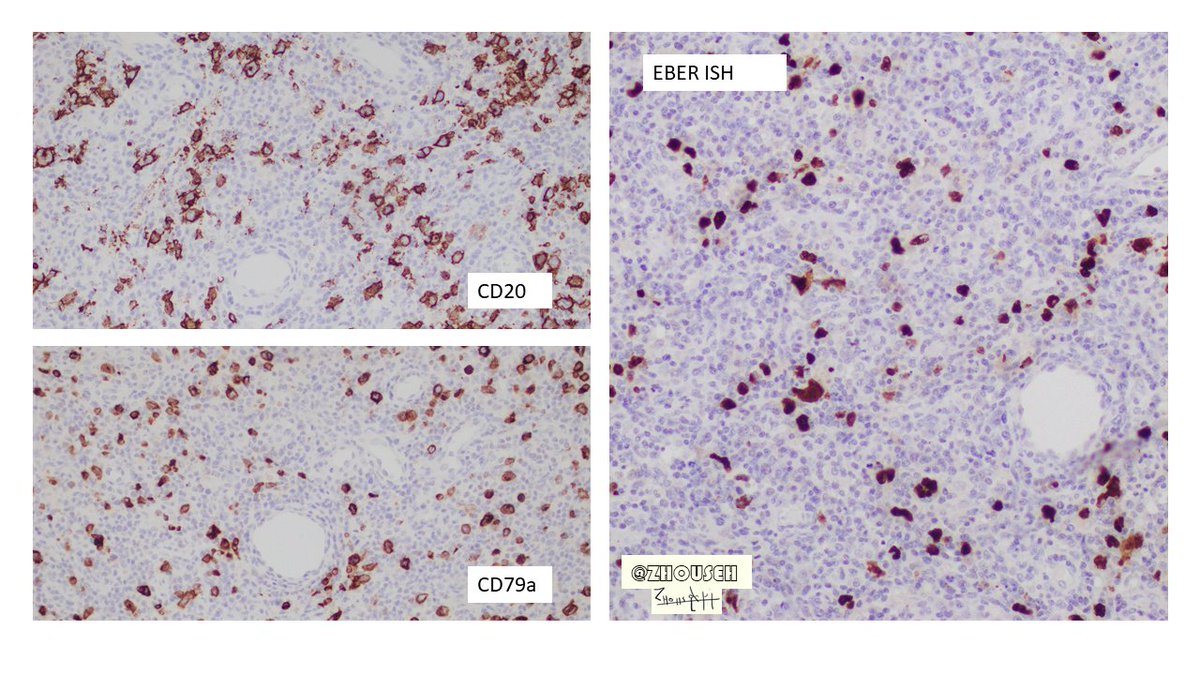 Back on Track - One case Theme :  #hemepath Generalized lymphadenopathyAxillary lymph node @TristanRutland7  @MattieFarzin  @KMirza  @pembeoltulu  @TheKarenPinto  @DrGeeONE  @MAHoureih  @SDeMicheleMD  @kis_lorand  @AmandaIreland1  #PathTwitter  #pathology  #surgpath  #Liverpoolpath