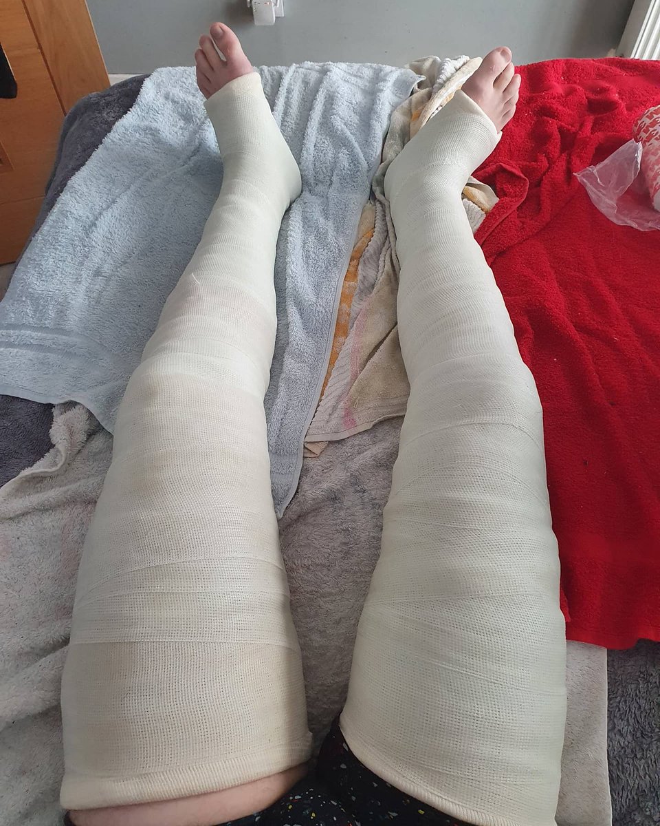 Purplejonesy's tweet photo. The beginning of my last cast adventure..a lovely DLLC. How i have missed casting.
#llc #legcast #longlegcast #fibre #fibrecast #cast #casting #encased #encase #encase #casts #castlife #fulllegcast #getcasted #castfetish #castbondage #bdsm #bdsmcommunity #kink #kinky https://t.co/QIvZZcEwxA