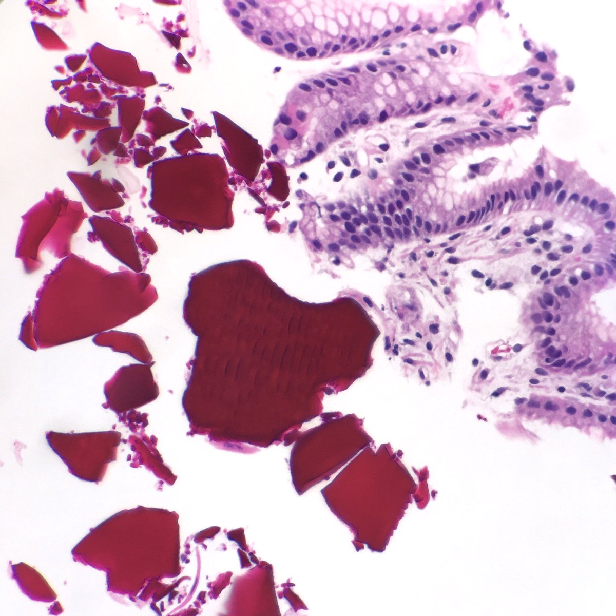 MFeelyDO's tweet image. There’s something fishy about this colesevelam... #GIpath #pathology