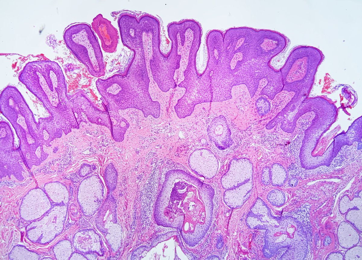 Papillomatosis dermatology