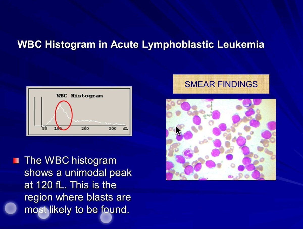 Swathiprabhu5's tweet photo. Cyto histogram correlation wonderfully explained by Dr Sukesh Nair . few slides highlighting the same. #KAPCON2020 #hemepath #PathTwitter @kciapm @Thejaspatho @suraksharaob @belurkar_sushma @LakshmiKoulmane https://t.co/MaApG7OPUy