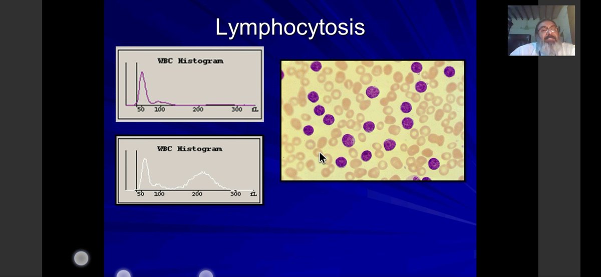 Swathi Prabhu, MD (@swathiprabhu5) on Twitter photo Cyto histogram correlation wonderfully explained by Dr Sukesh Nair . few slides highlighting the same. #KAPCON2020 #hemepath #PathTwitter <a href="/kciapm/">Karnataka Chapter-IAPM (KCIAPM)</a> <a href="/Thejaspatho/">Thejas K Murthy</a> <a href="/suraksharaob/">Dr. Suraksha.Rao B</a> <a href="/belurkar_sushma/">Sushma Belurkar</a> <a href="/LakshmiKoulmane/">Sindhura Lakshmi</a> Cyto histogram correlation wonderfully explained by Dr Sukesh Nair . few slides highlighting the same. #KAPCON2020 #hemepath #PathTwitter <a href="/kciapm/">Karnataka Chapter-IAPM (KCIAPM)</a> <a href="/Thejaspatho/">Thejas K Murthy</a> <a href="/suraksharaob/">Dr. Suraksha.Rao B</a> <a href="/belurkar_sushma/">Sushma Belurkar</a> <a href="/LakshmiKoulmane/">Sindhura Lakshmi</a>