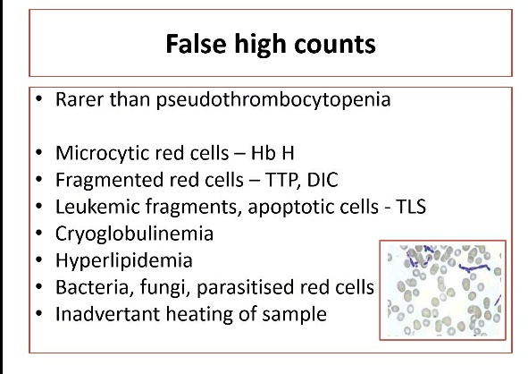 Archana bhat (@archibhat3) on Twitter photo Morphology in hematopathology made much more interesting with beautiful images by Dr Debadutta Basu sir. #Hematopath #hematology #KAPCON2020 <a href="/adi_agnihotri/">Aditya Agnihotri 🇮🇳</a> <a href="/pembeoltulu/">Pembe Oltulu, MD</a> <a href="/VijayPatho/">Vijay Shankar S</a> <a href="/Vasudevprabhu3/">Vasudev Prabhu</a> <a href="/suraksharaob/">Dr. Suraksha.Rao B</a> <a href="/DrRamaswamyAS/">Dr Ramaswamy AS MD</a> <a href="/Thejaspatho/">Thejas K Murthy</a> <a href="/NippoPaul/">Nithin Paul NipPO</a> <a href="/drsupriyatiwari/">Dr. Supriya Tiwari</a> <a href="/RPoral/">Rashmi Poral MD, DNB</a> Morphology in hematopathology made much more interesting with beautiful images by Dr Debadutta Basu sir. #Hematopath #hematology #KAPCON2020 <a href="/adi_agnihotri/">Aditya Agnihotri 🇮🇳</a> <a href="/pembeoltulu/">Pembe Oltulu, MD</a> <a href="/VijayPatho/">Vijay Shankar S</a> <a href="/Vasudevprabhu3/">Vasudev Prabhu</a> <a href="/suraksharaob/">Dr. Suraksha.Rao B</a> <a href="/DrRamaswamyAS/">Dr Ramaswamy AS MD</a> <a href="/Thejaspatho/">Thejas K Murthy</a> <a href="/NippoPaul/">Nithin Paul NipPO</a> <a href="/drsupriyatiwari/">Dr. Supriya Tiwari</a> <a href="/RPoral/">Rashmi Poral MD, DNB</a>