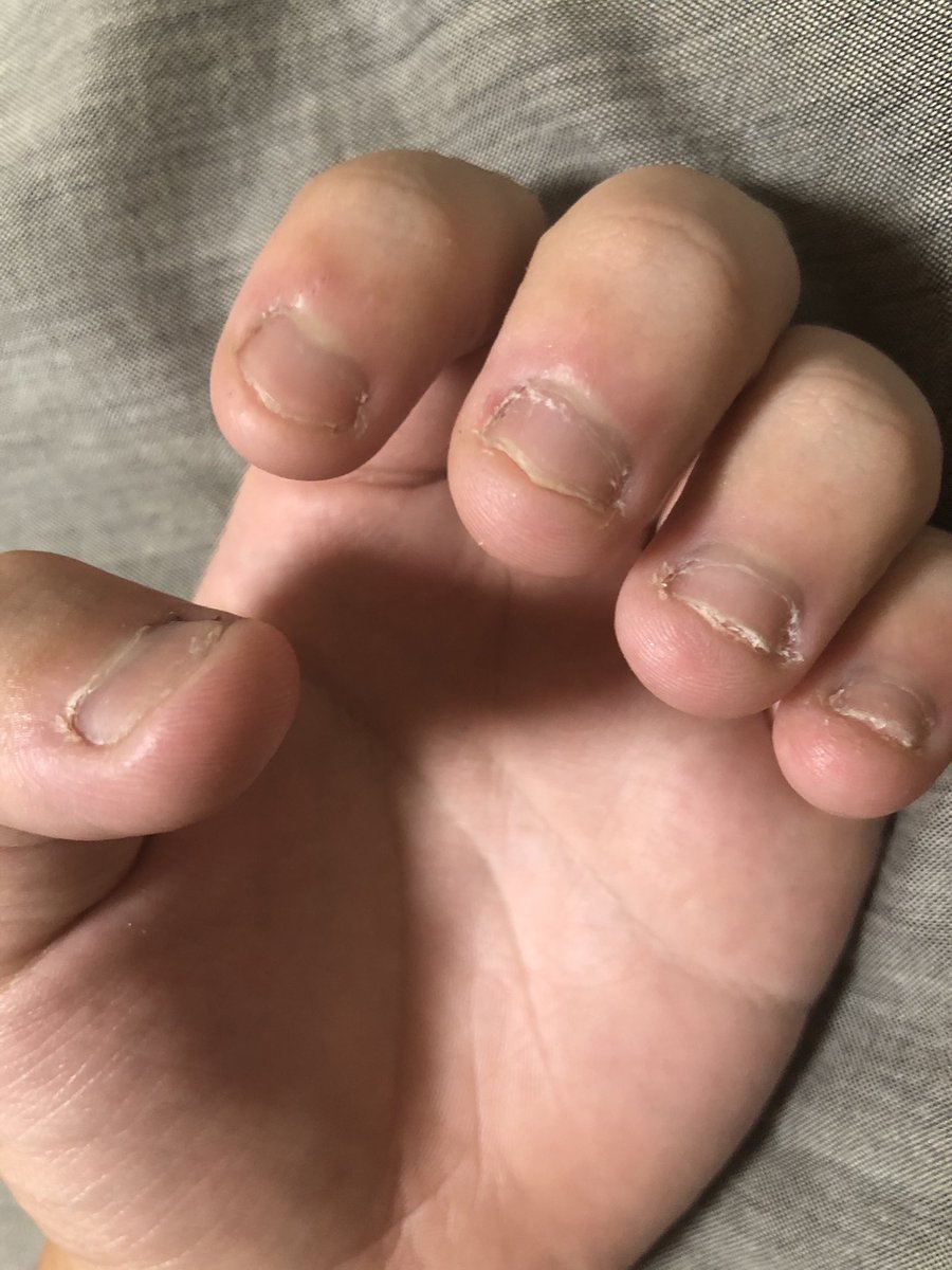 爪噛むの直したい人 Ulneaqj1giwlvyt Twitter