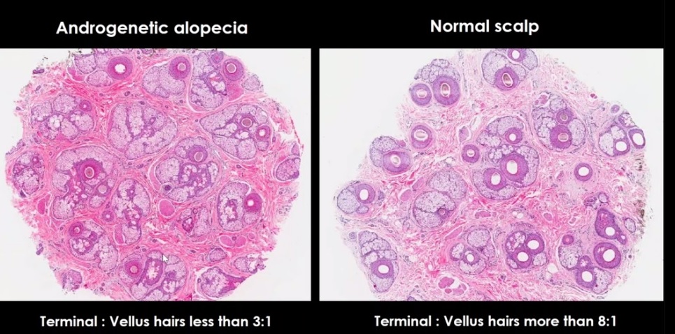 Nithin Paul NipPO (@nippopaul) on Twitter photo Androgenetic alopecia. Aproach to alopecia - Dr. Joyce Lee #dermatopathology #KAPCON2020 #KCIAPM #pathtwitter <a href="/adi_agnihotri/">Aditya Agnihotri ๐ฎ๐ณ</a> <a href="/drsupriyatiwari/">Dr. Supriya Tiwari</a> <a href="/DrNithyashree/">Dr NithYASHree</a> <a href="/VijayPatho/">Vijay Shankar S</a> <a href="/Thejaspatho/">Thejas K Murthy</a> <a href="/suraksharaob/">Dr. Suraksha.Rao B</a> <a href="/Swathiprabhu5/">Swathi Prabhu, MD</a> <a href="/deepnadig/">Deepak M Nadig</a> <a href="/DrRamaswamyAS/">Dr Ramaswamy AS MD</a> <a href="/vi_monappa/">Vidya Monappa</a> <a href="/padmapathology1/">Padma Priya J</a> <a href="/archibhat3/">Archana bhat</a> Androgenetic alopecia. Aproach to alopecia - Dr. Joyce Lee #dermatopathology #KAPCON2020 #KCIAPM #pathtwitter <a href="/adi_agnihotri/">Aditya Agnihotri ๐ฎ๐ณ</a> <a href="/drsupriyatiwari/">Dr. Supriya Tiwari</a> <a href="/DrNithyashree/">Dr NithYASHree</a> <a href="/VijayPatho/">Vijay Shankar S</a> <a href="/Thejaspatho/">Thejas K Murthy</a> <a href="/suraksharaob/">Dr. Suraksha.Rao B</a> <a href="/Swathiprabhu5/">Swathi Prabhu, MD</a> <a href="/deepnadig/">Deepak M Nadig</a> <a href="/DrRamaswamyAS/">Dr Ramaswamy AS MD</a> <a href="/vi_monappa/">Vidya Monappa</a> <a href="/padmapathology1/">Padma Priya J</a> <a href="/archibhat3/">Archana bhat</a>