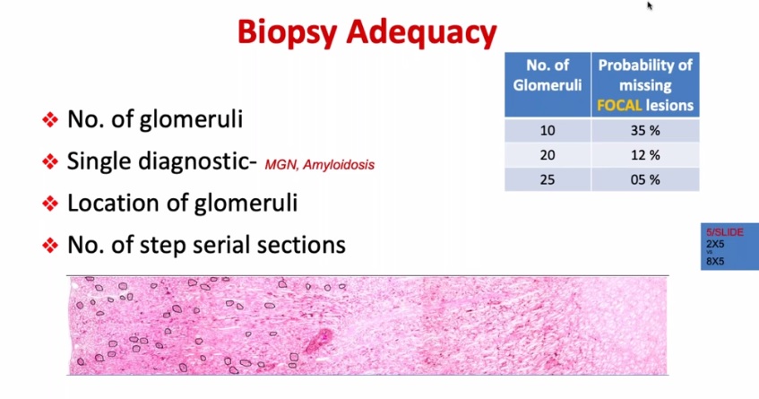 Nithin Paul NipPO (@nippopaul) on Twitter photo Criteria for biopsy adequacy for renal biopsy. Basics of Nephropathology patterns - Dr. Ritambhara Nada #nephropathology #KAPCON2020 #KCIAPM #pathtwitter
<a href="/adi_agnihotri/">Aditya Agnihotri ๐ฎ๐ณ</a>
<a href="/drsupriyatiwari/">Dr. Supriya Tiwari</a>
<a href="/DrNithyashree/">Dr NithYASHree</a>
<a href="/VijayPatho/">Vijay Shankar S</a>
<a href="/Thejaspatho/">Thejas K Murthy</a>
<a href="/suraksharaob/">Dr. Suraksha.Rao B</a>
<a href="/Swathiprabhu5/">Swathi Prabhu, MD</a> Criteria for biopsy adequacy for renal biopsy. Basics of Nephropathology patterns - Dr. Ritambhara Nada #nephropathology #KAPCON2020 #KCIAPM #pathtwitter
<a href="/adi_agnihotri/">Aditya Agnihotri ๐ฎ๐ณ</a>
<a href="/drsupriyatiwari/">Dr. Supriya Tiwari</a>
<a href="/DrNithyashree/">Dr NithYASHree</a>
<a href="/VijayPatho/">Vijay Shankar S</a>
<a href="/Thejaspatho/">Thejas K Murthy</a>
<a href="/suraksharaob/">Dr. Suraksha.Rao B</a>
<a href="/Swathiprabhu5/">Swathi Prabhu, MD</a>