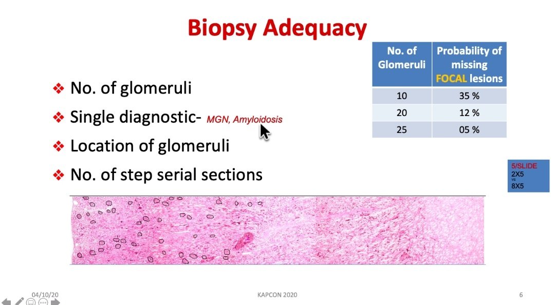 Dr. Supriya Tiwari (@drsupriyatiwari) on Twitter photo Another important thing to remember as residents! The biopsy adequacy - #Nephropathology session live right now at #KAPCON2020
<a href="/AchLekha/">Srilekha</a>
<a href="/NippoPaul/">Nithin Paul NipPO</a>
<a href="/DrNithyashree/">Dr NithYASHree</a>
<a href="/RPoral/">Rashmi Poral MD, DNB</a>
@ThePathoGuy Another important thing to remember as residents! The biopsy adequacy - #Nephropathology session live right now at #KAPCON2020
<a href="/AchLekha/">Srilekha</a>
<a href="/NippoPaul/">Nithin Paul NipPO</a>
<a href="/DrNithyashree/">Dr NithYASHree</a>
<a href="/RPoral/">Rashmi Poral MD, DNB</a>
@ThePathoGuy