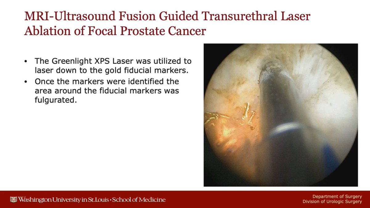 ChrisArett's tweet photo. I’m excited to share my innovative MRI fusion guided transurethral focal laser ablation for prostate cancer at the #FOCAL2020 conference #prostate #uronav #greenlight Watch “Poster 18_Arett” on #Vimeo https://t.co/jgY1c5YHgz https://t.co/kYHp5lSnd6
