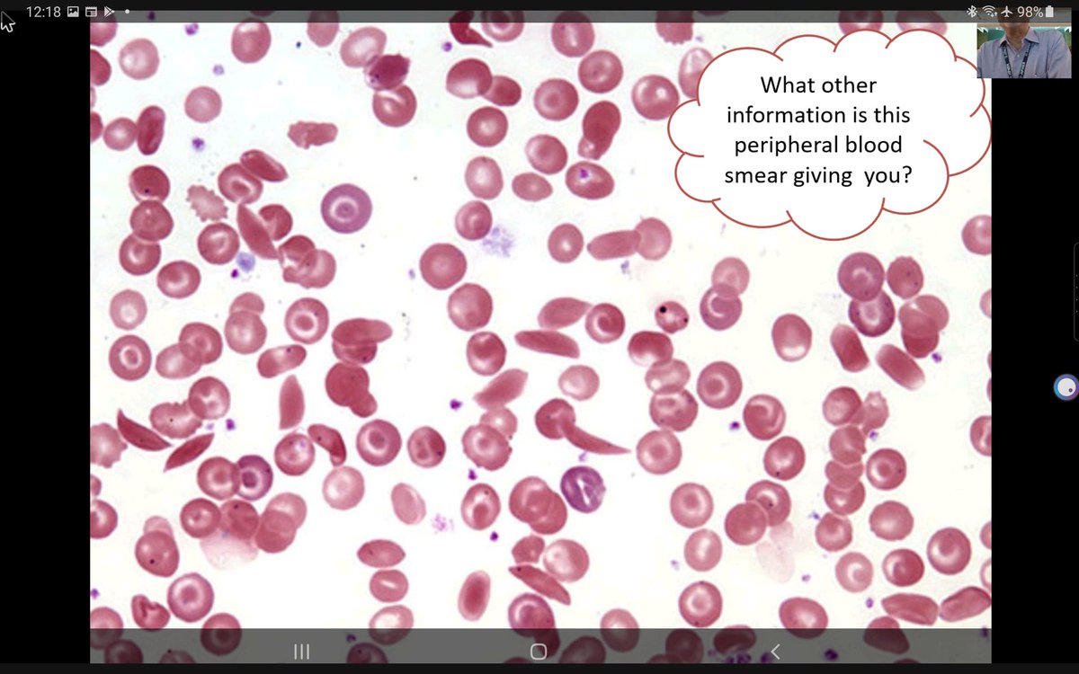 Importance of peripheral smear cannot be overemphasized!!!
Its crucial to diagnosis!!  #hematology #hemepath
Courtesy of Dr.Debdutta basu . #KAPCON2020 <a href="/vi_monappa/">Vidya Monappa</a> <a href="/padmapathology1/">Padma Priya J</a> <a href="/drsupriyatiwari/">Dr. Supriya Tiwari</a> <a href="/NippoPaul/">Nithin Paul NipPO</a> <a href="/anjuthevirgo/">Anju Pandey</a> <a href="/DrNithyashree/">Dr NithYASHree</a> <a href="/pathodoodles/">Pathodoodles by Deeksha Sikri</a>