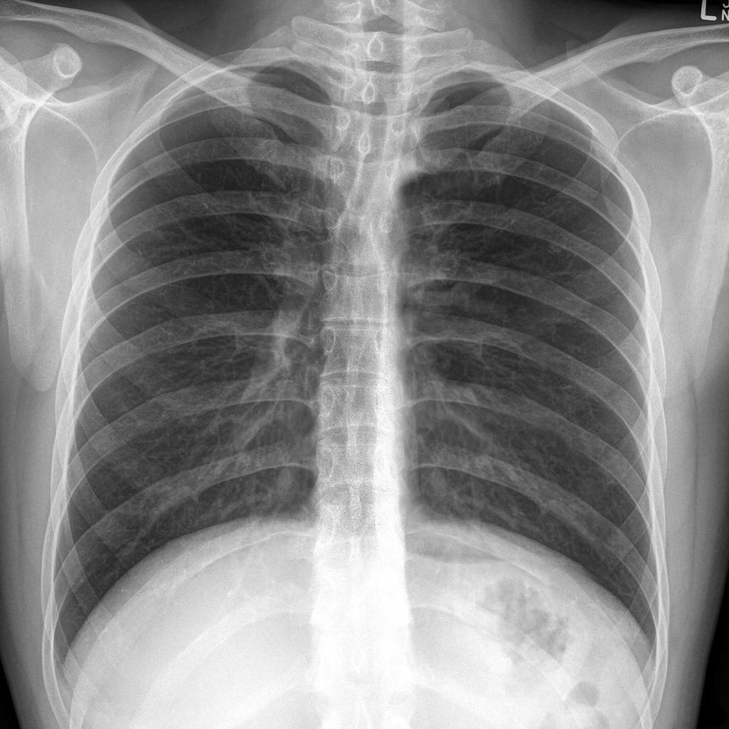 BREAKING. Trump’s chest x-ray with “findings as expected.”