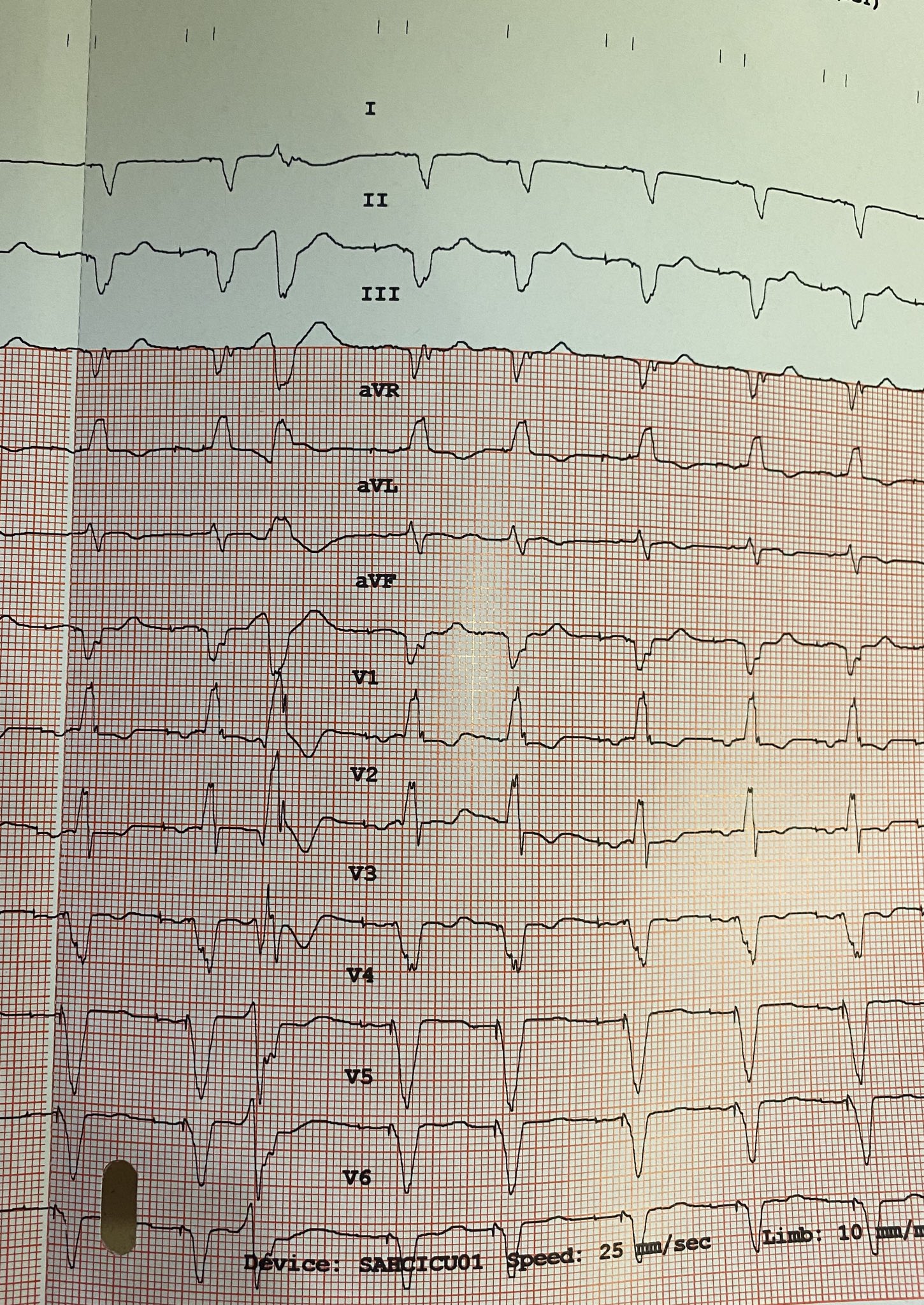 Experts Reveal The Best Kept Secrets About Pvc Icd 10 - 6hp45ob