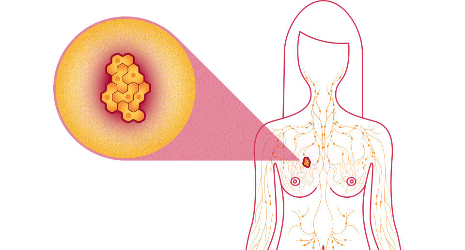 #شهر_التوعية_بسرطان_الثدي 
#BreastCancerAwarenessMonth

هل تعلم 🤔

سرطان الثدي مرض تتشكل فيه الخلايا الخبيثة (السرطانية) في أنسجة الثدي