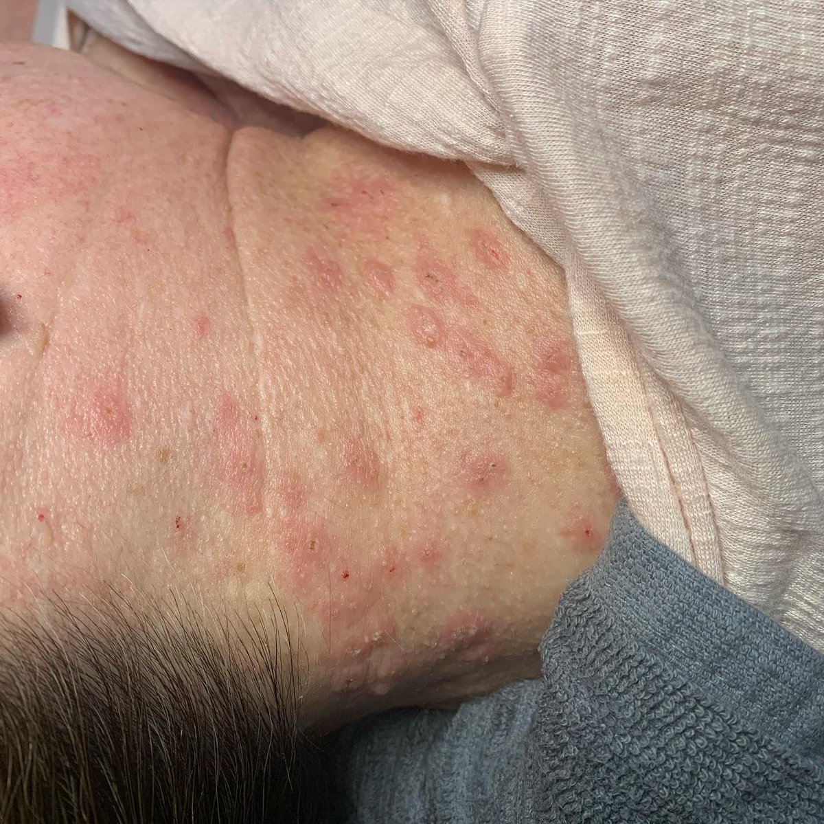 electrolysisllc's tweet photo. 🚨Skin tags can be hereditary but you don’t have to live with them. ✅Redness will go away in 2-3 days and the area will be clear and even to your skin. #electroysis #iloveyourskin #iloveyourface #skintagremoval #skintagsremoval #skintags #skintag https://t.co/RpyCaqiz84