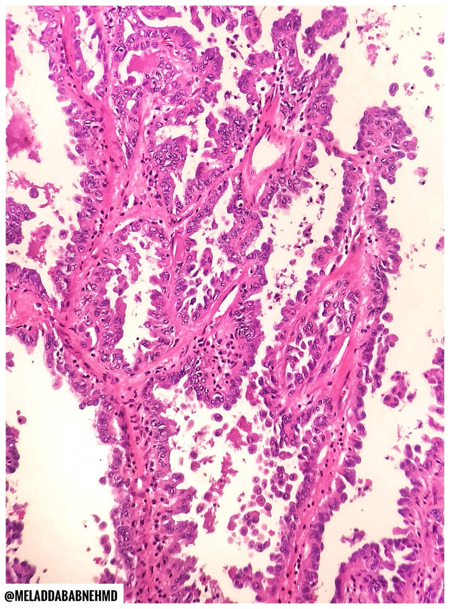 EmoryPathology's tweet photo. 🔬 EMORY CASE OF THE WEEK #9
55 y/o with a thyroid mass adhesed to strap muscles. Bethesda VI on FNA smears.
Answer the question below!
Contributor: @MeladDababnehMD
#EmoryCoTW #ENTpath #ThyroidPath #EndoPath #emorypathres #path2path #PathTwitter https://t.co/CNCjB7QgrF